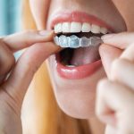 Invisalign Your Path To A Perfect Smile