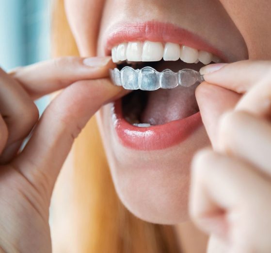 Invisalign Your Path To A Perfect Smile