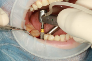Important Considerations about Various Types of Dental Implants