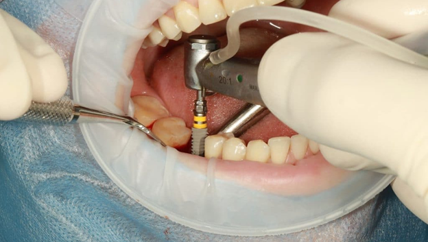 Important Considerations about Various Types of Dental Implants