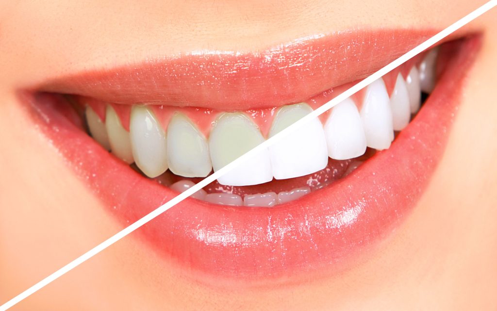 Potential Risks Associated with Office Whitening