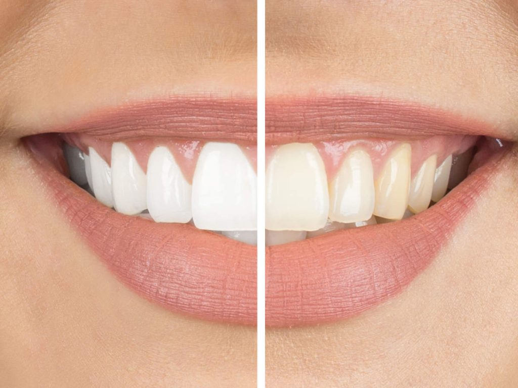 Can Dental Veneers Be a Replacement for Teeth Whitening? 