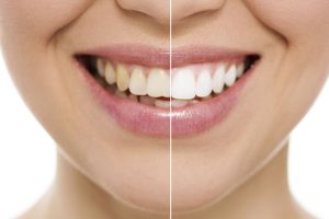 Is Teeth Whitening an Expensive Cosmetic Dental Procedure