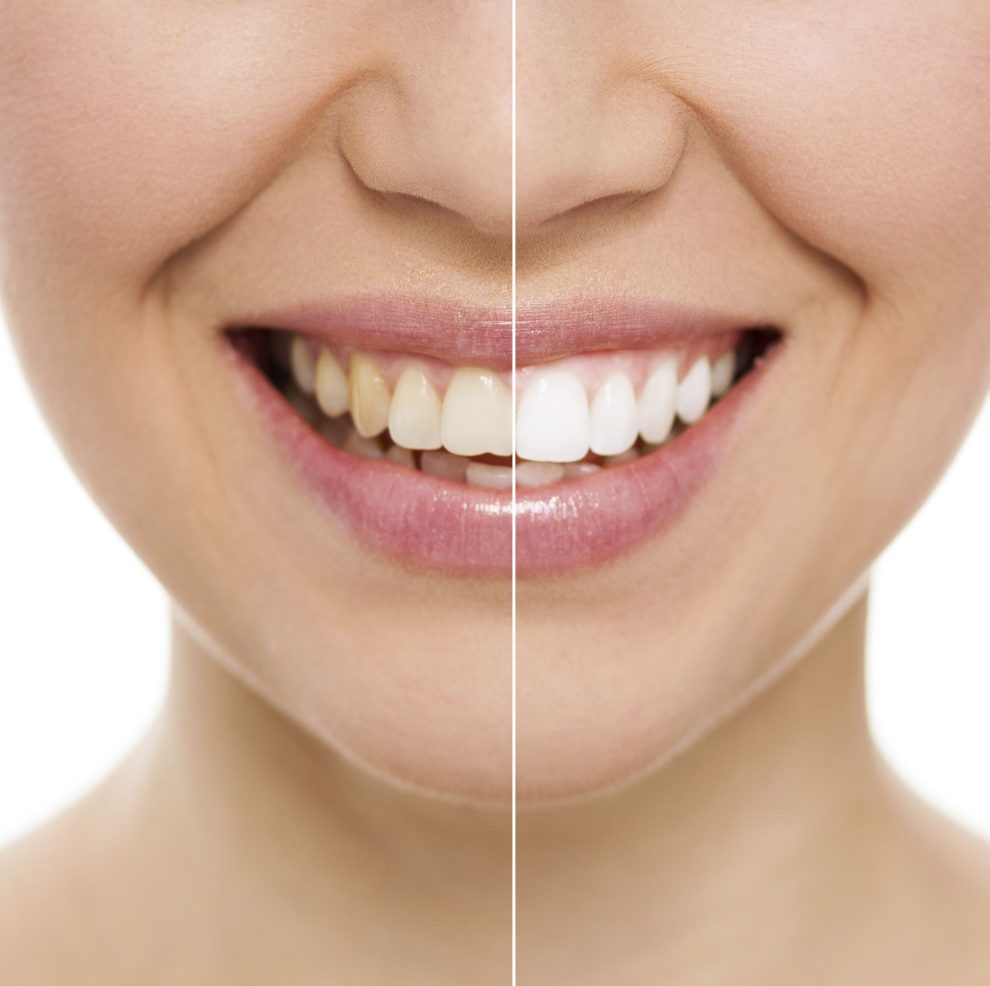 Is Teeth Whitening an Expensive Cosmetic Dental Procedure